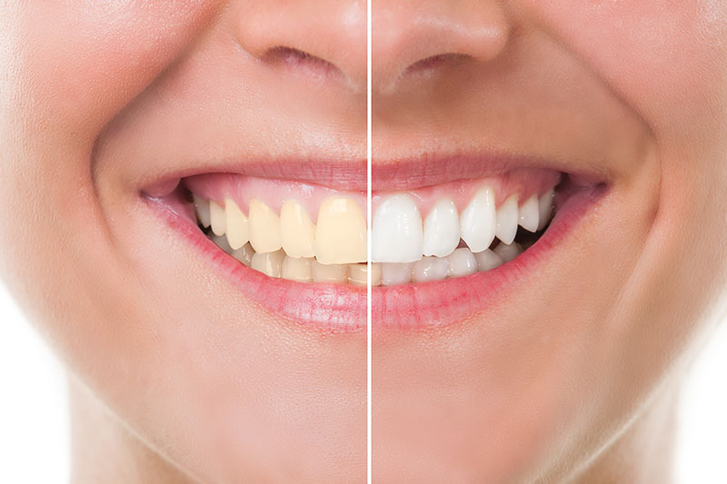 Teeth Whitening in Oradell